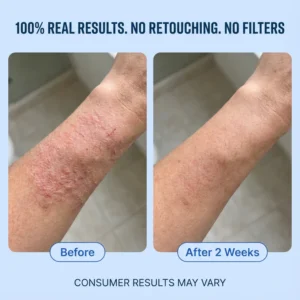 Neuvo Eczema & Psoriasis Cream