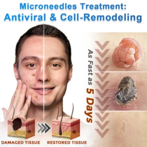 GFOUK Microneedle Flawless Skin Tag Removal Patch