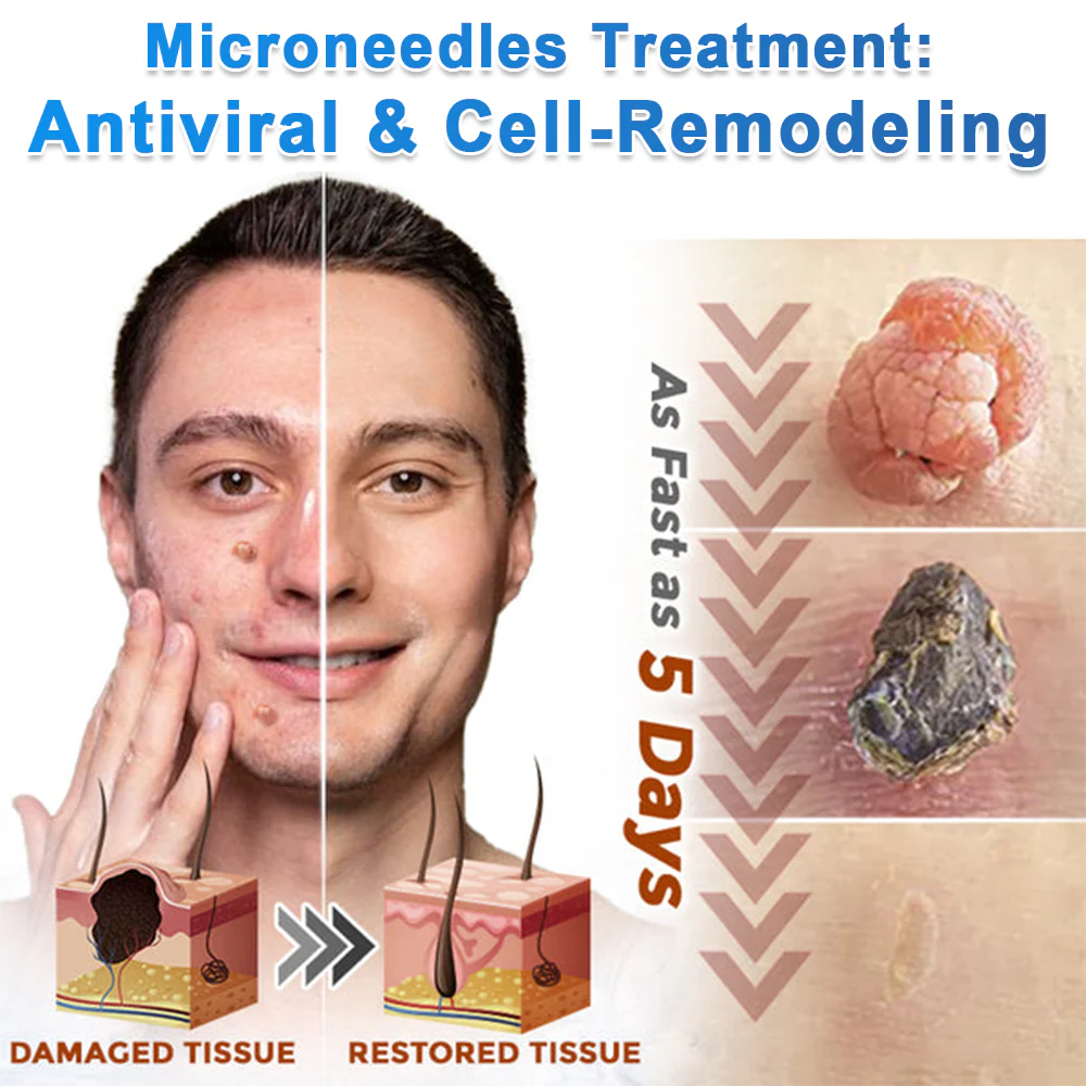GFOUK Microneedle Flawless Skin Tag Removal Patch