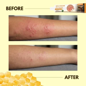 RZXEA™ Bee Venom Bio-Peptide 2-Min Instant Itch Relief Cream